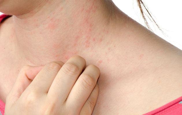 How to stop the Eczema itch - Dermatique Sensitive Skincare
