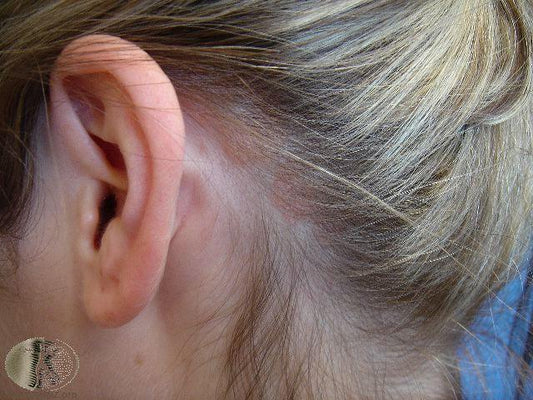 Psoriasis on the scalp. Dermatique can help - Dermatique Sensitive Skincare