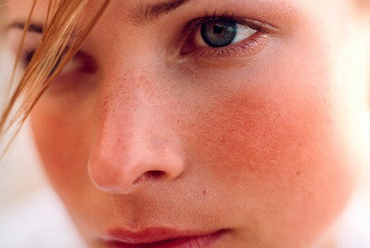 Natural treatment for Rosacea - Dermatique Sensitive Skincare