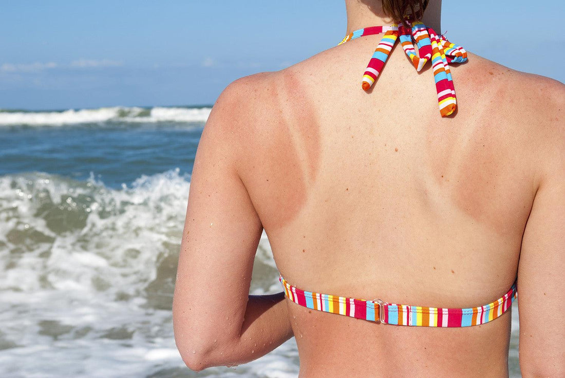 How to heal sunburn quickly - Dermatique Sensitive Skincare