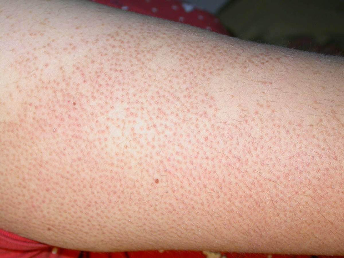 Products and advice for treating Keratosis Pilaris (KP) - Dermatique Sensitive Skincare